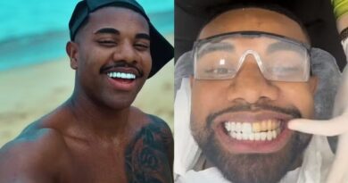Ex-BBB Davi Brito se arrepende e troca de lentes de contato dos dentes após virar piada na web: “Estava muito grande”