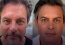 Luigi Baricelli compartilha antes e depois de harmonização facial