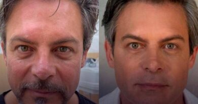 Luigi Baricelli compartilha antes e depois de harmonização facial