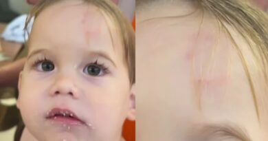 Virgínia Fonseca expõe machucado do filho após mordida na escola